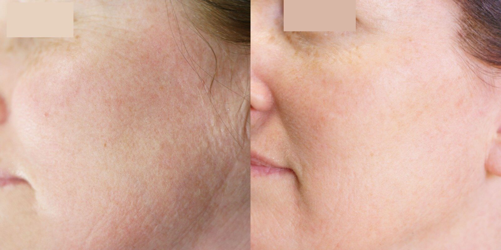 Anti-Aging Treatment Lily Dermal Care