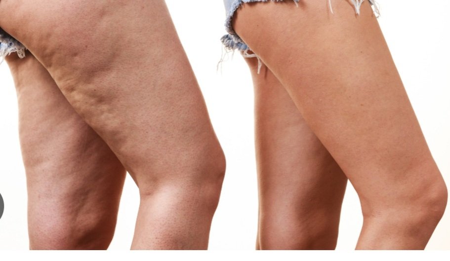 Cellulite Cellulite