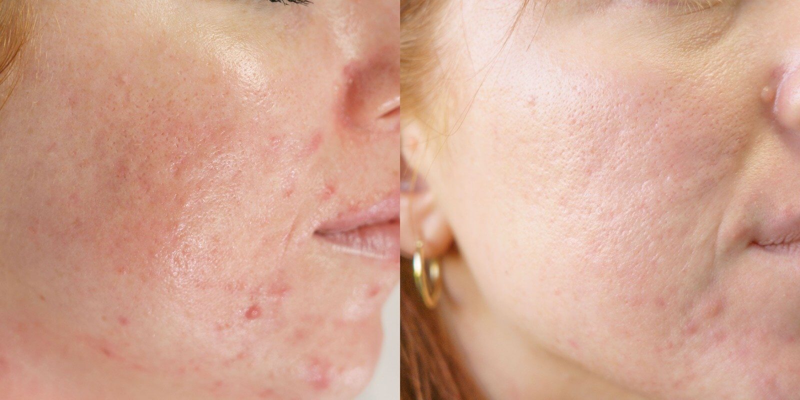 Anti-Aging Treatment Lily Dermal Care